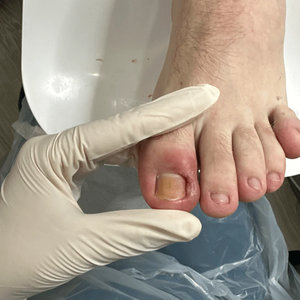 Podiatrist examining an inflamed ingrown toenail on a big toe