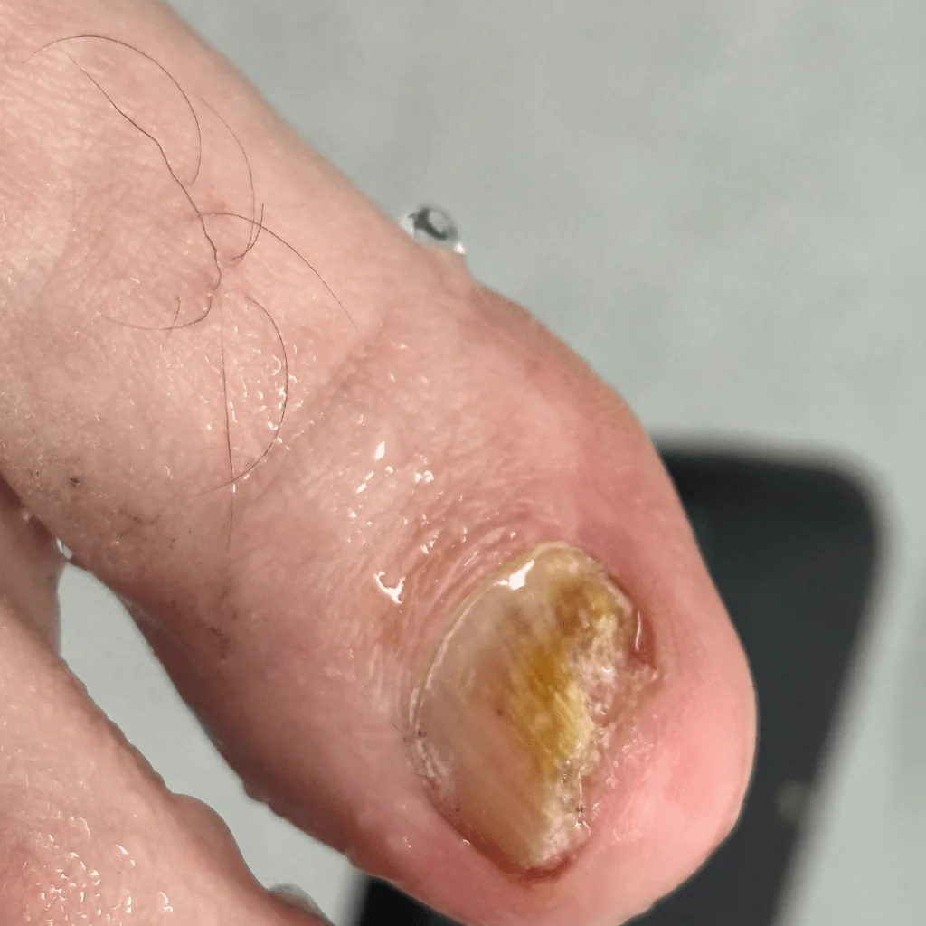 Close-up of a thickened, discoloured toenail before fungal nail treatment