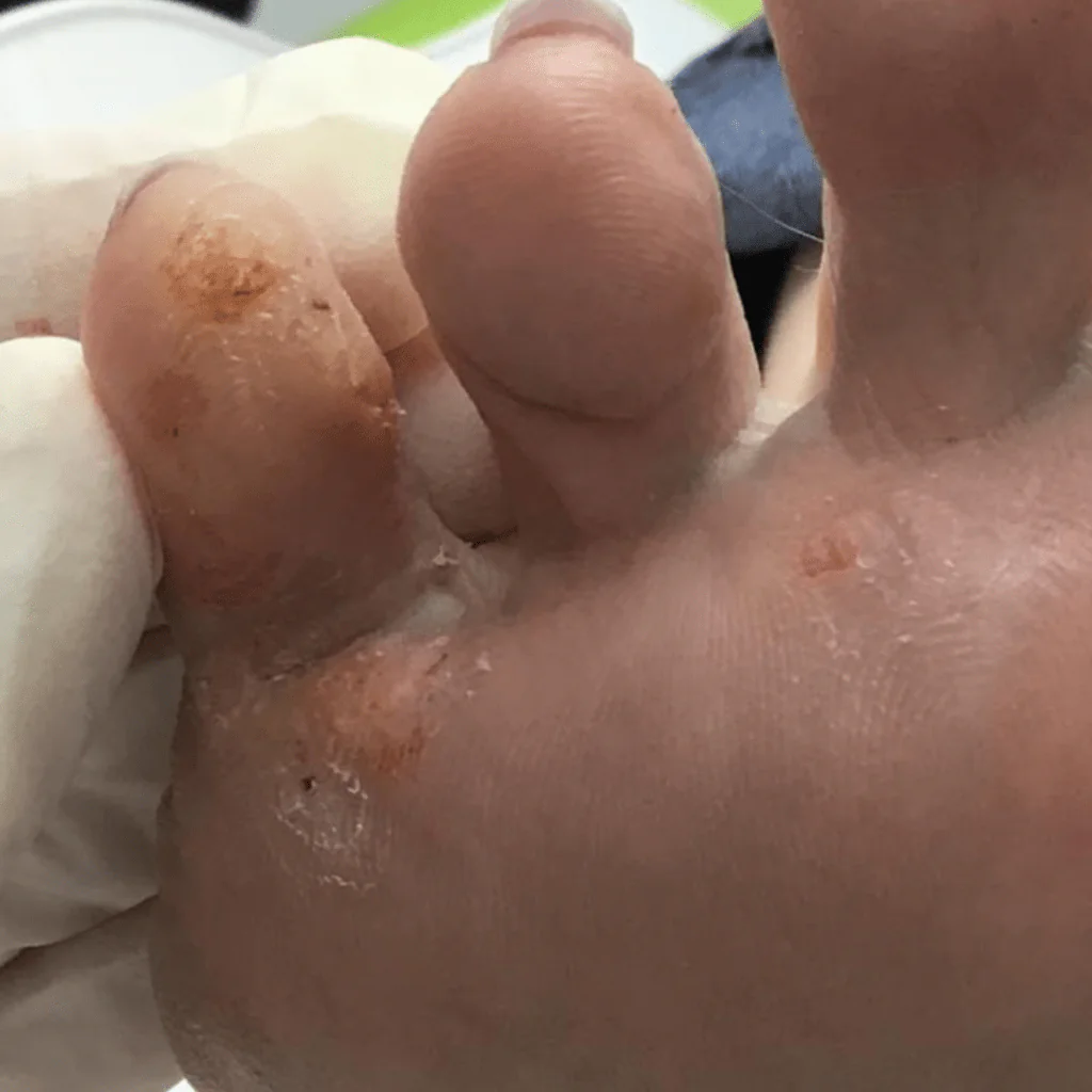 Close-up of verrucae on the underside of a foot
